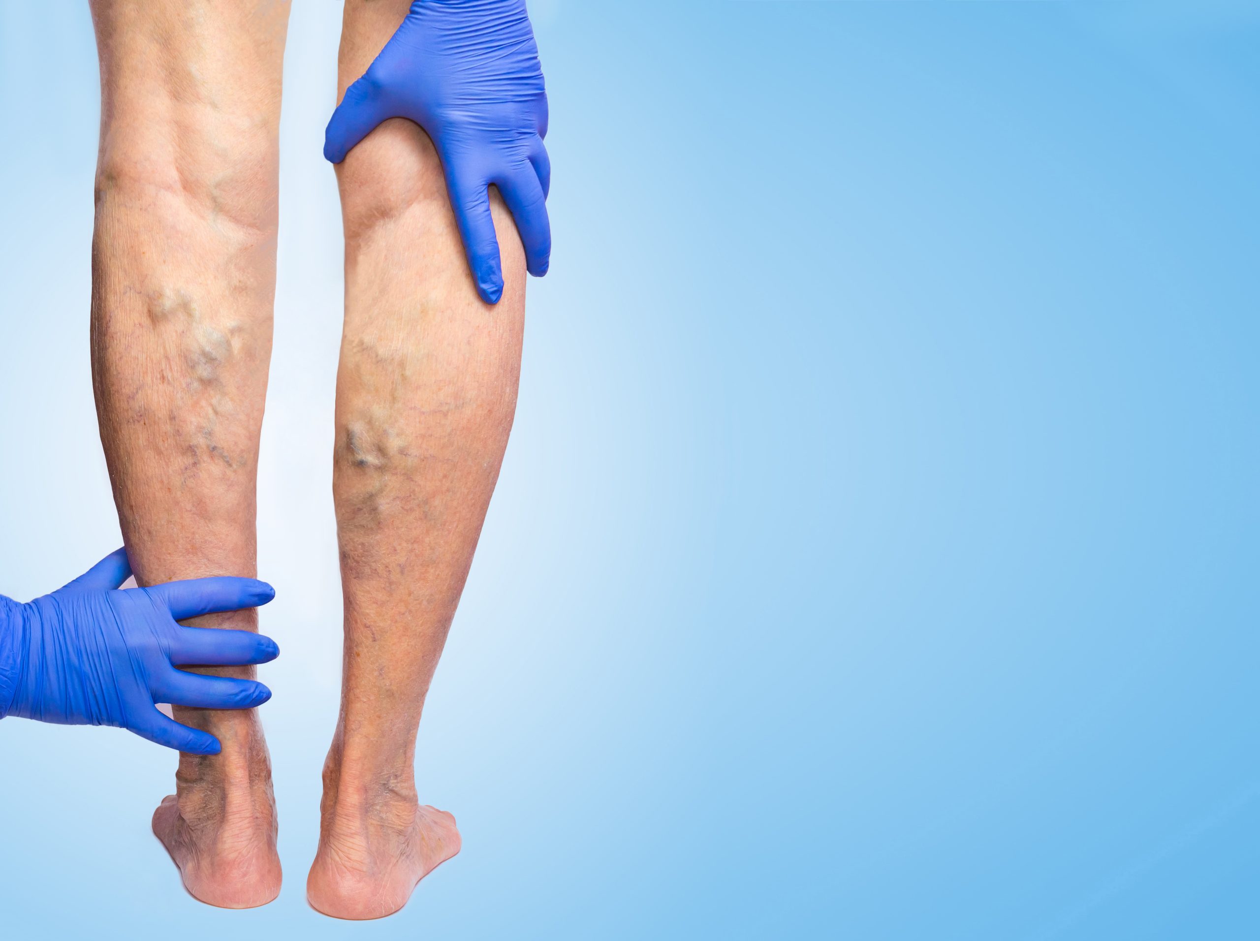 Venous insufficiency, like this poor patient's swollen varicose veins as a doctor inspects them, is a condition that should be looked at immediately.