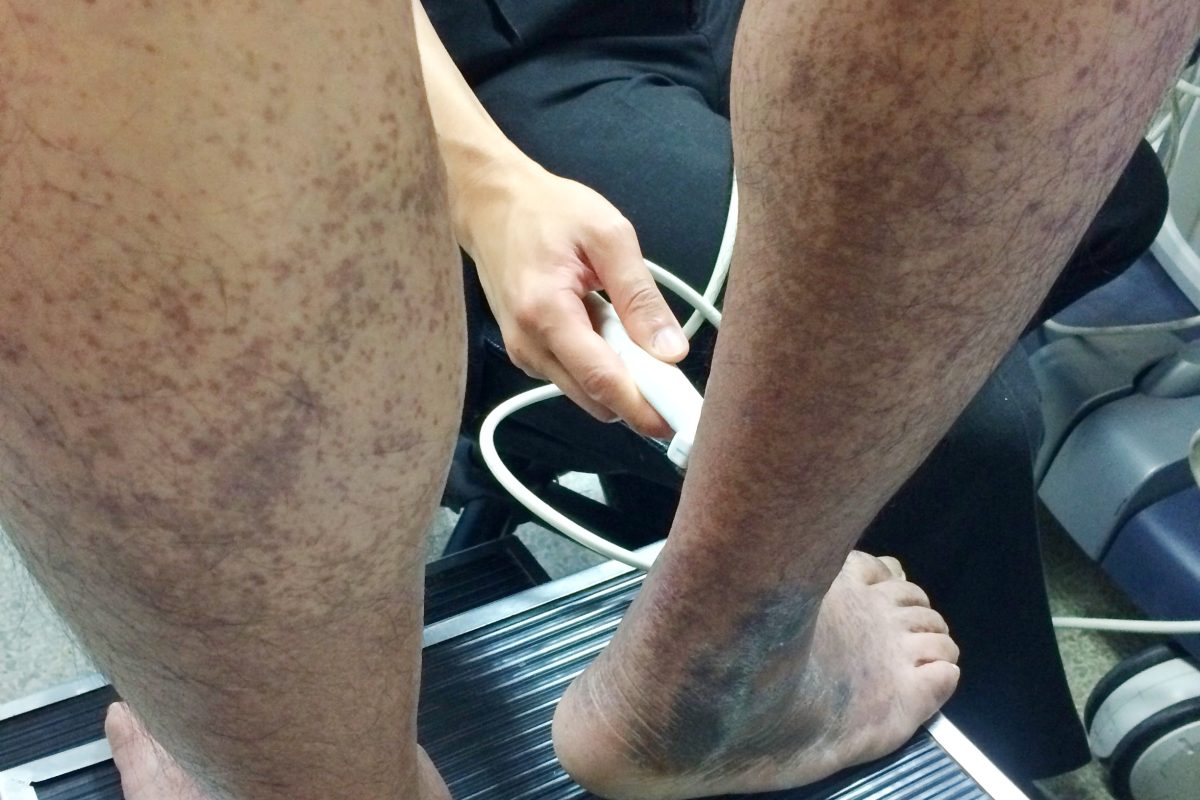 Venous stasis treatment is illustrated in this overweight man's legs as a leg vein doctor performs tests on his lower extremities.