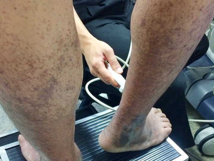 Venous stasis treatment is illustrated in this overweight man's legs as a leg vein doctor performs tests on his lower extremities.