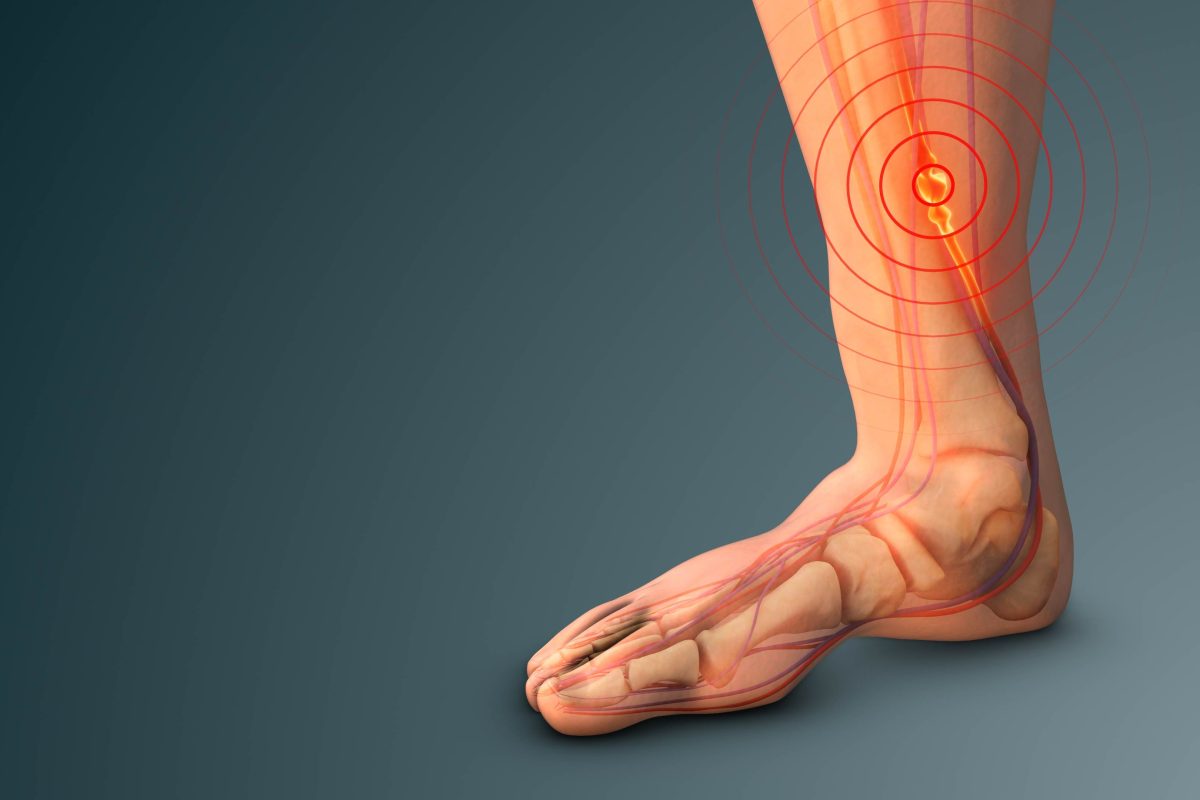 This medical graphical diagram of veins and nerves in a human's leg and foot is illustrative of the concept of vein ablation for diabetic leg pain.