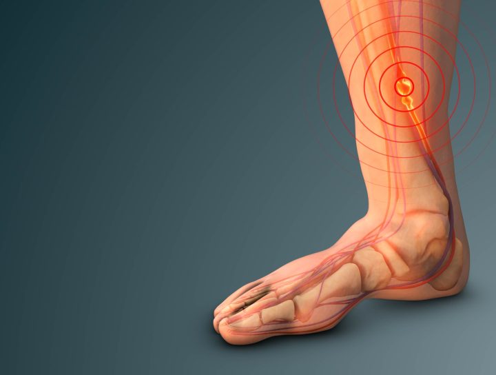 This medical graphical diagram of veins and nerves in a human's leg and foot is illustrative of the concept of vein ablation for diabetic leg pain.