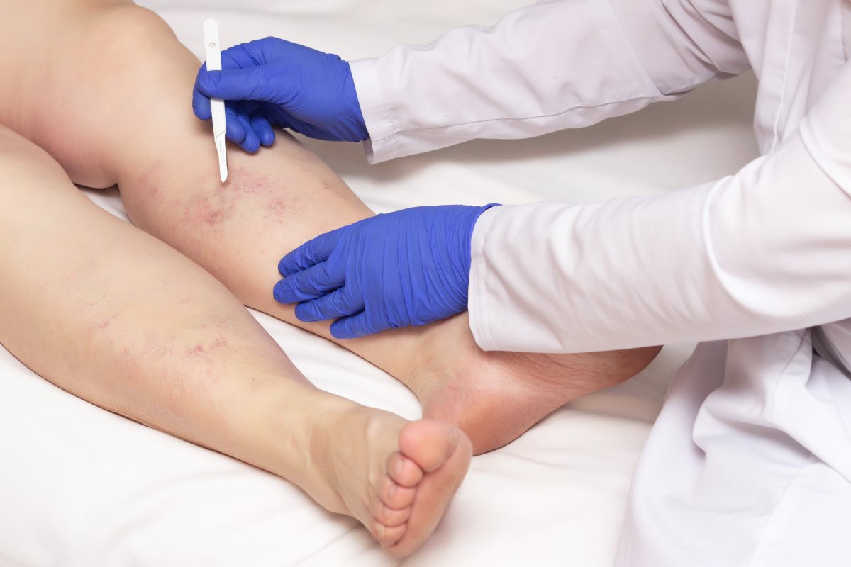 To treat varicose veins, the first step is to contact a pain management specialist, like this image of a woman's legs being analyzed by a vein doctor.