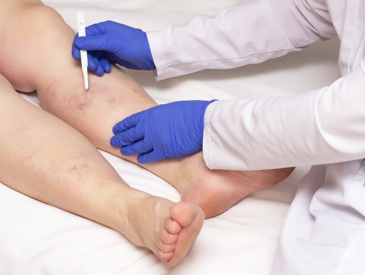 To treat varicose veins, the first step is to contact a pain management specialist, like this image of a woman's legs being analyzed by a vein doctor.