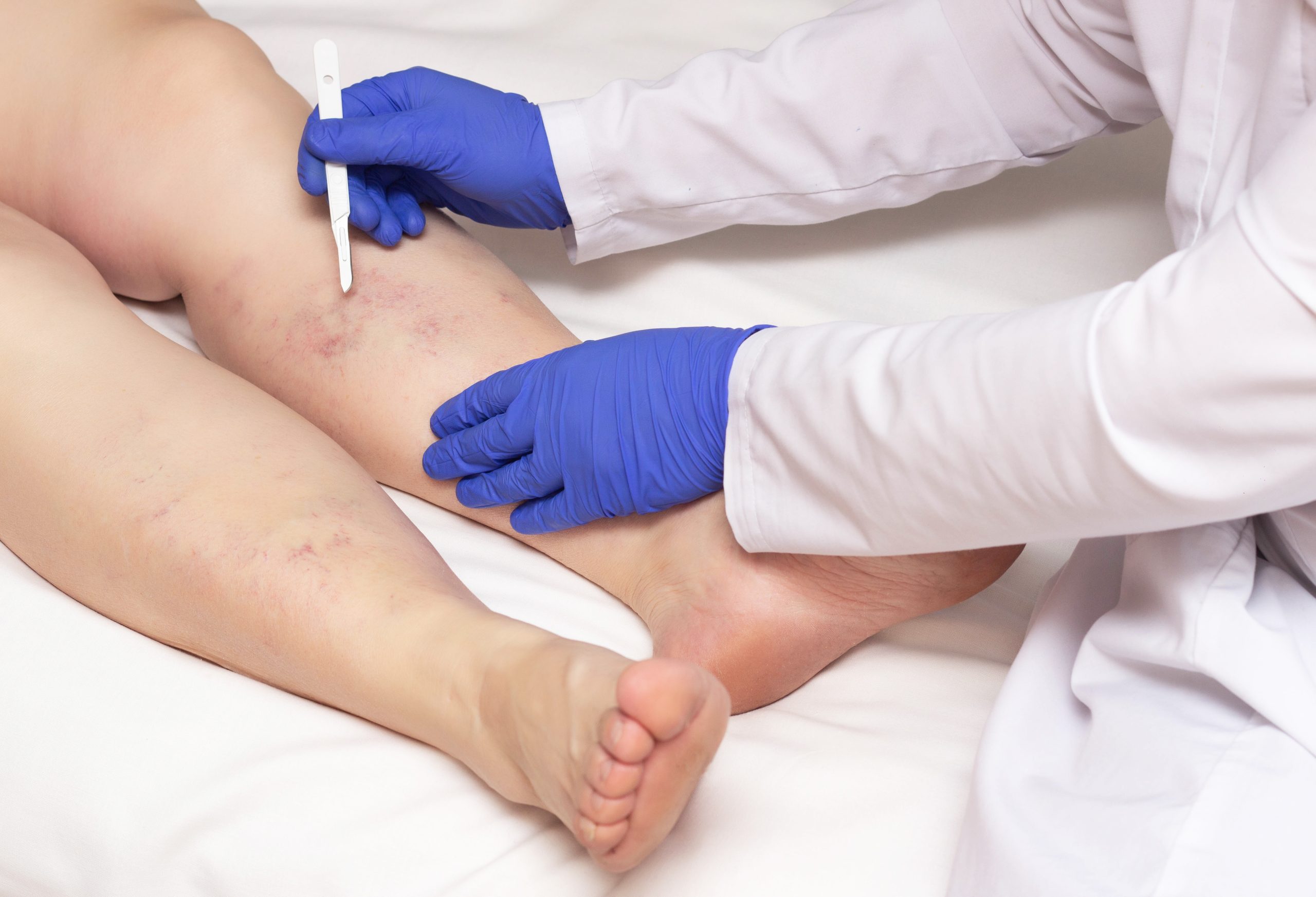 To treat varicose veins, the first step is to contact a pain management specialist, like this image of a woman's legs being analyzed by a vein doctor.