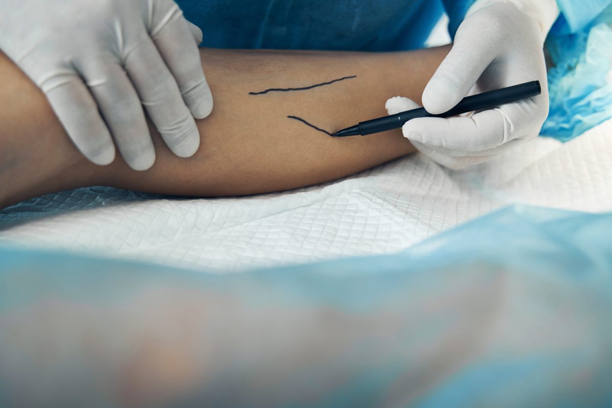 Spider veins treatment starts with a pain management specialist or vein doctor examining your legs carefully, as illustrated by this doctor marking a patients leg with a pen.