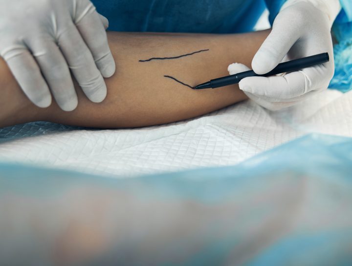 Spider veins treatment starts with a pain management specialist or vein doctor examining your legs carefully, as illustrated by this doctor marking a patients leg with a pen.