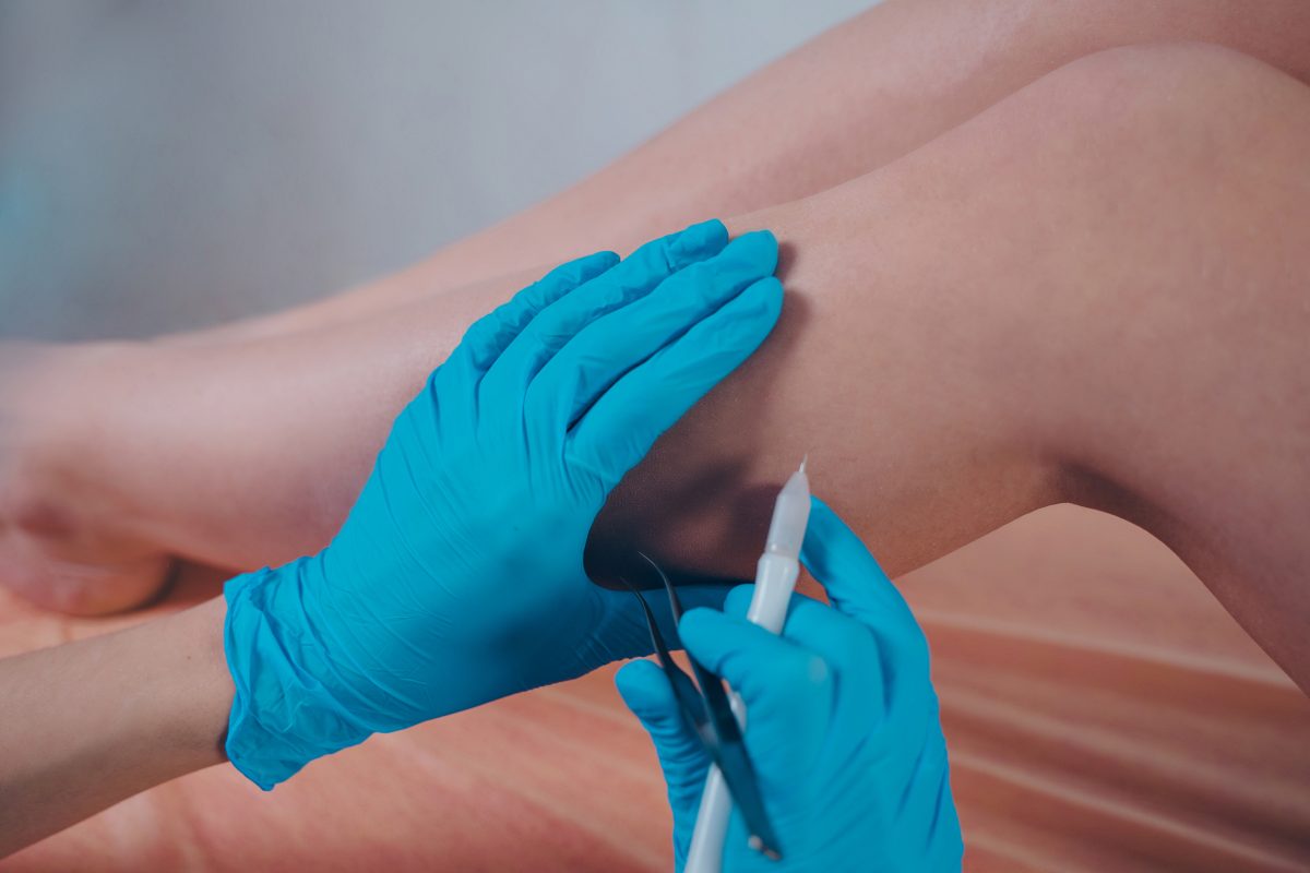 A vein specialist doctor marks a patient's legs, preparing her for varicose veins surgery.