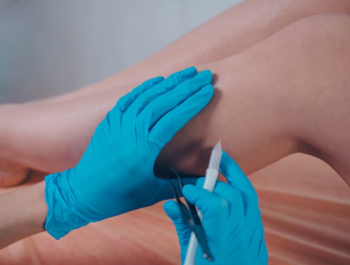 A vein specialist doctor marks a patient's legs, preparing her for varicose veins surgery.
