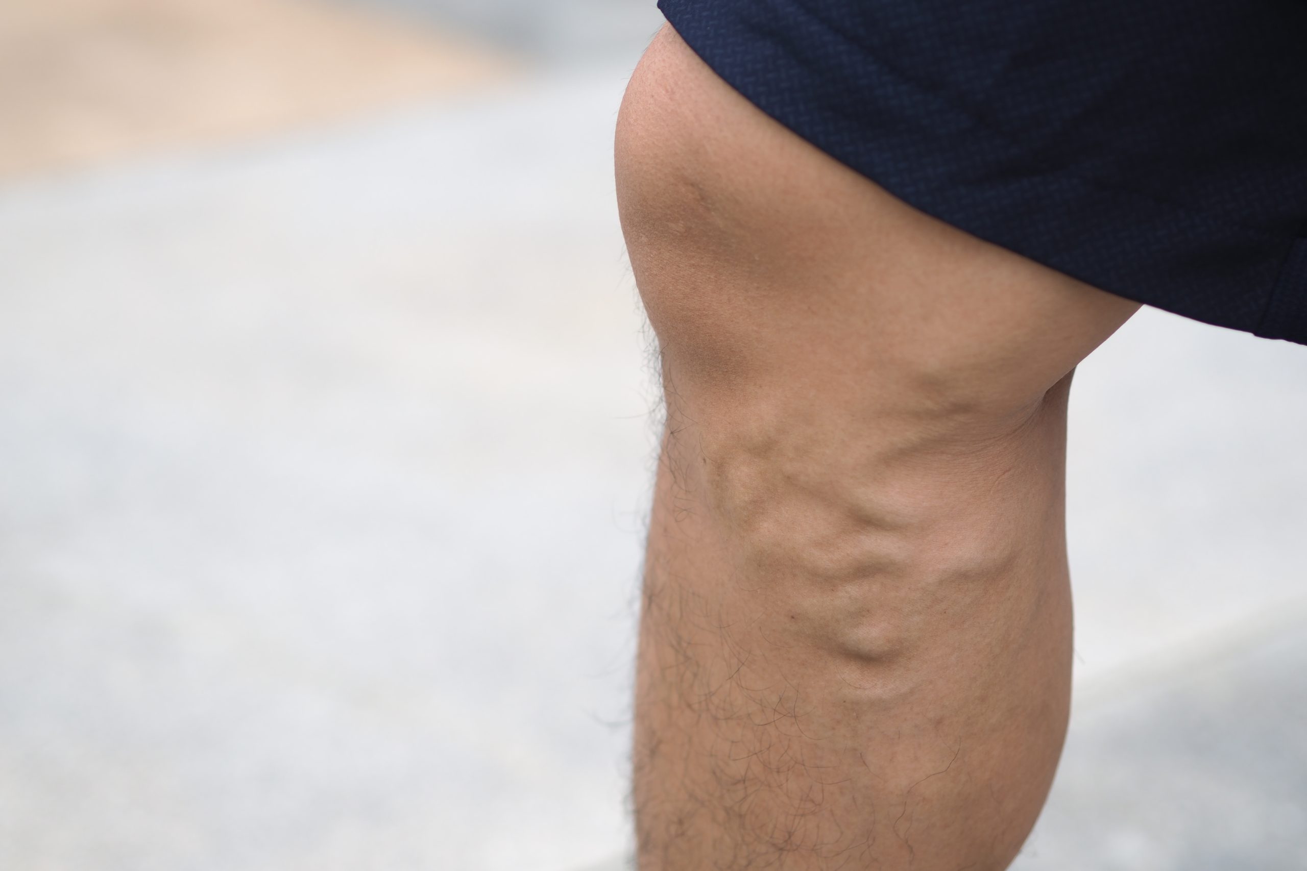 Leg vein removal treatment is a whole body reset, as evidenced by this obese male patient's noticeable veins in his leg and other health issues.