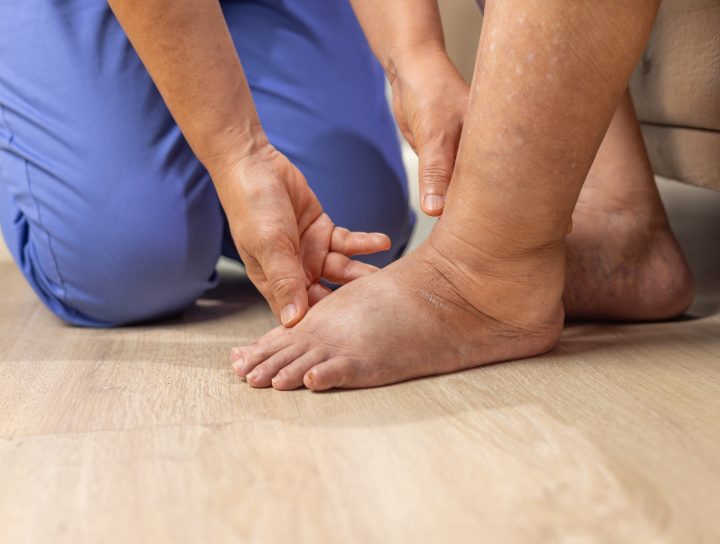 A woman with a puffy, heavy leg seeks out swollen leg treatment from a pain management specialist doctor.