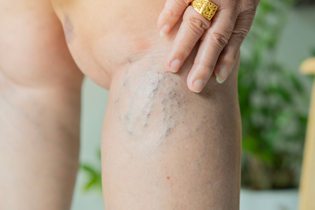 Spider vein legs are caused by venous facts, not myths, as illustrated by this middle-age woman's spider veins on her legs as she touches them.