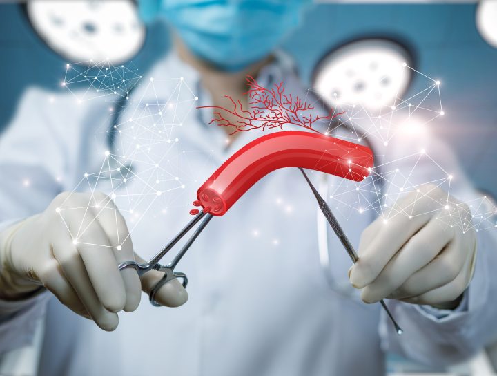 A doctor-with-utensils illustrative visual of treating blood vessels through blood circulation surgery.