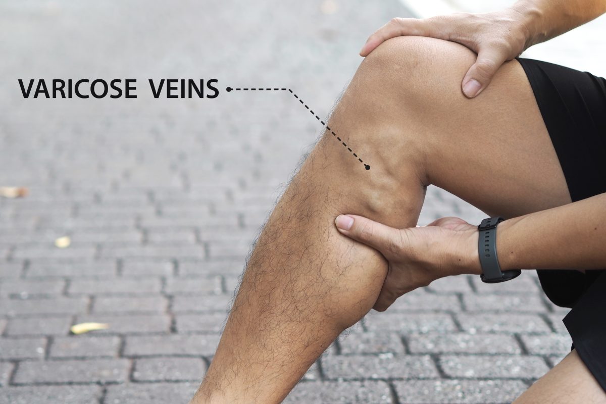 Minimally invasive cosmetic vein removal for males is essential, as illustrated by this man displaying varicose veins below his knee while sitting on a sidewalk outside.
