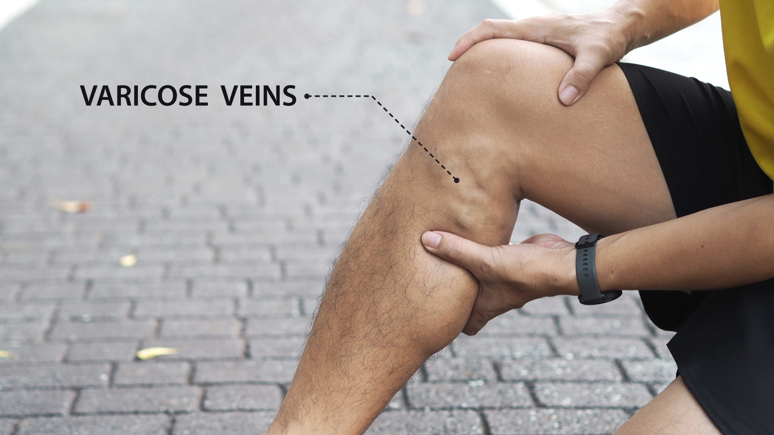 Minimally invasive cosmetic vein removal for males is essential, as illustrated by this man displaying varicose veins below his knee while sitting on a sidewalk outside.
