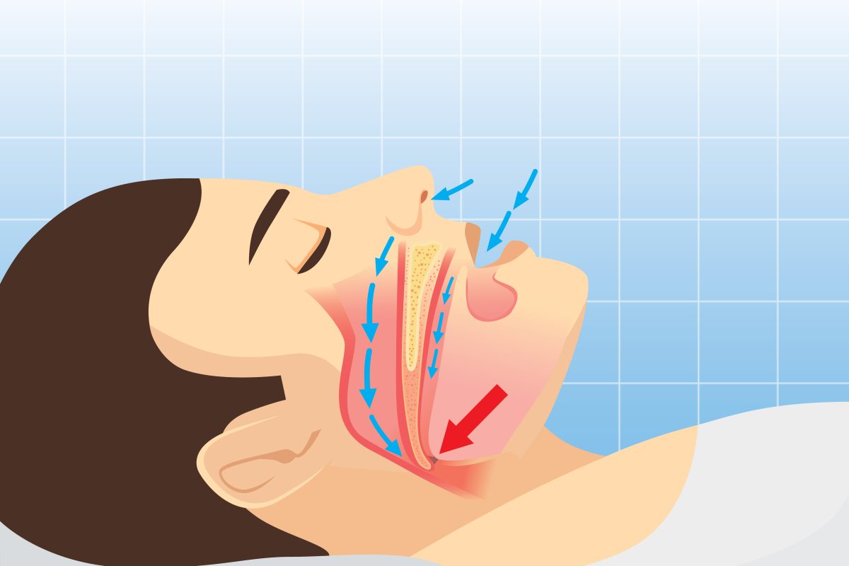 The need for a sleep apnea mouthpiece is visually illustrated by a graphical image of a man's head, with his mouth open, breathing during his evening rest.