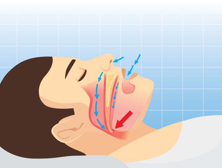 The need for a sleep apnea mouthpiece is visually illustrated by a graphical image of a man's head, with his mouth open, breathing during his evening rest.
