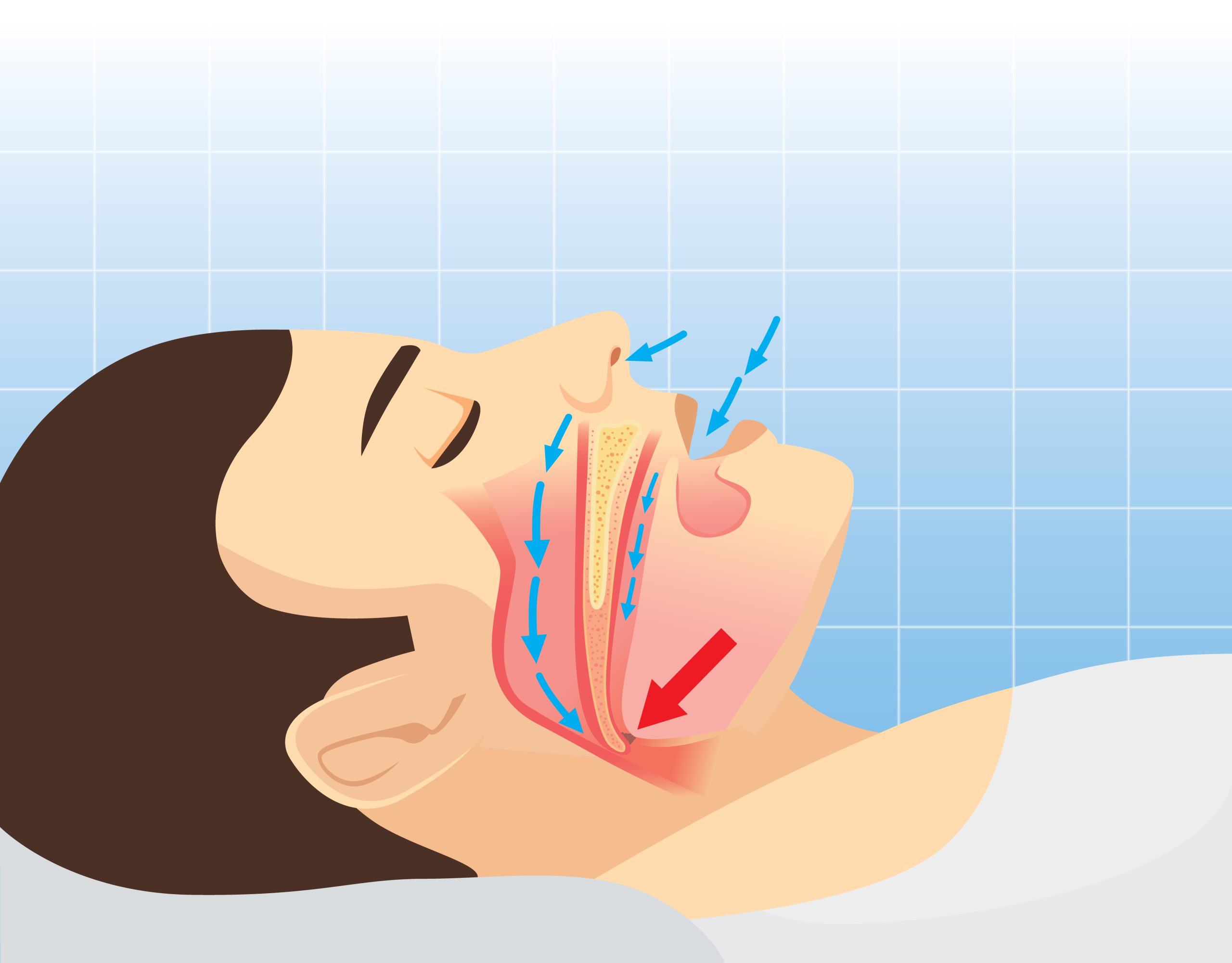 The need for a sleep apnea mouthpiece is visually illustrated by a graphical image of a man's head, with his mouth open, breathing during his evening rest.