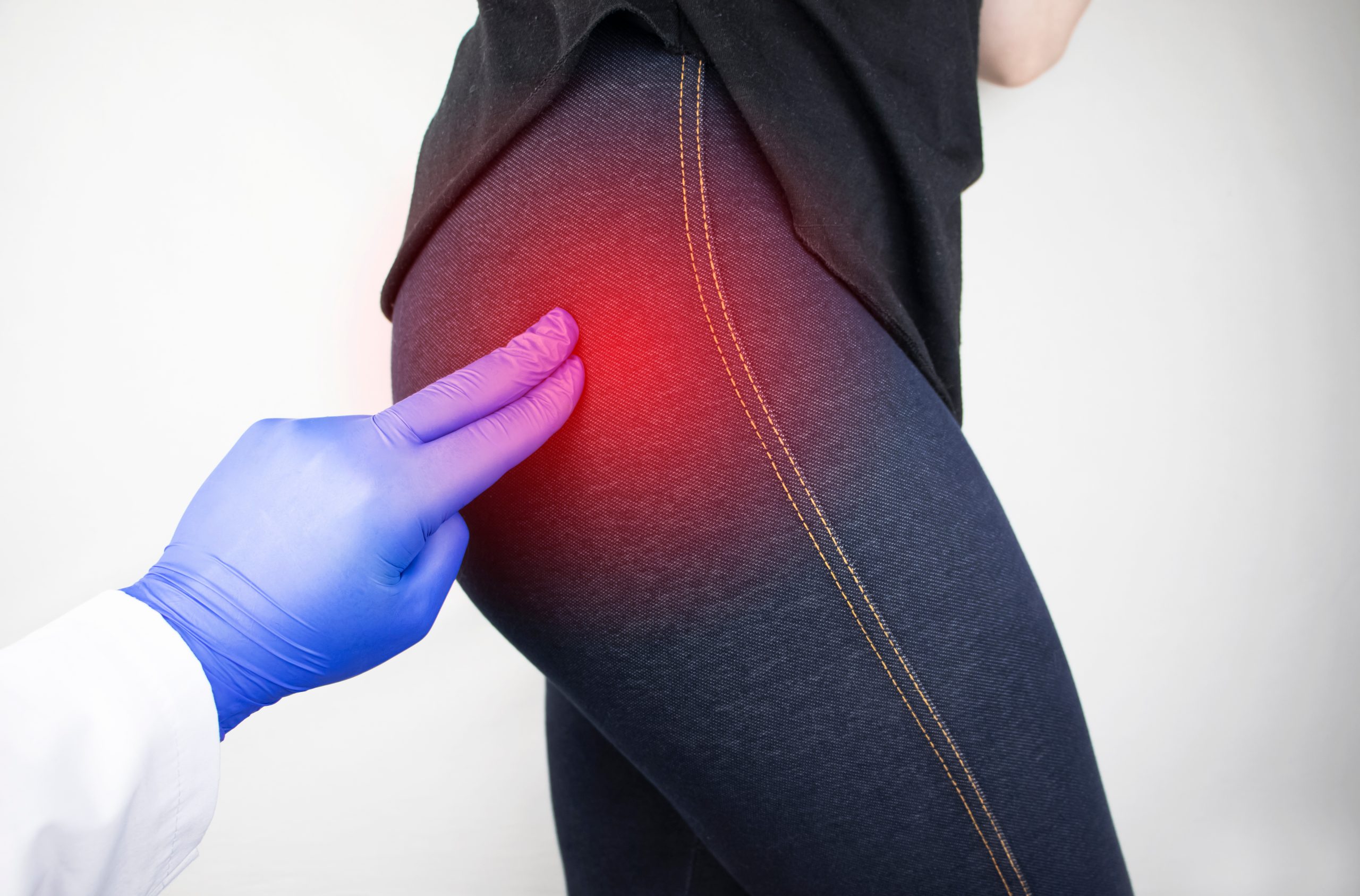 A pain management specialist's fingers pressing on radiating discomfort coming from a lady's hip and buttocks, illustrating sciatic nerve pain relief.