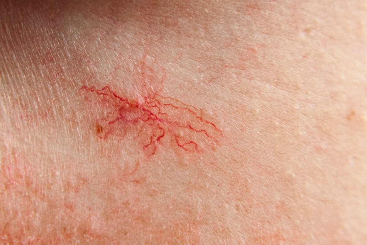 Spider vein cosmetic treatment can fix and restore unhealthy tiny veins like these on the skin surface of an individual's legs.