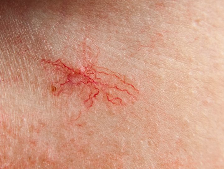 Spider vein cosmetic treatment can fix and restore unhealthy tiny veins like these on the skin surface of an individual's legs.