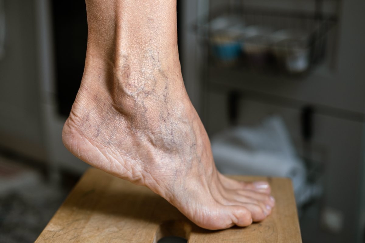 An older lady's foot displays dozens of spider veins as it arches and she thinks about spider vein removal.