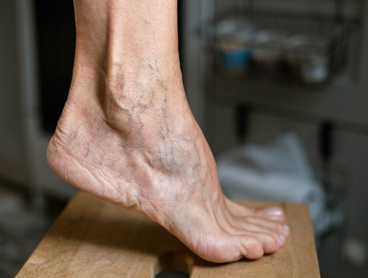 An older lady's foot displays dozens of spider veins as it arches and she thinks about spider vein removal.