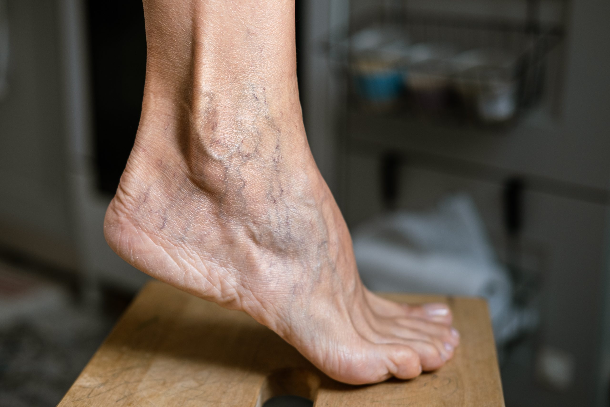 An older lady's foot displays dozens of spider veins as it arches and she thinks about spider vein removal.
