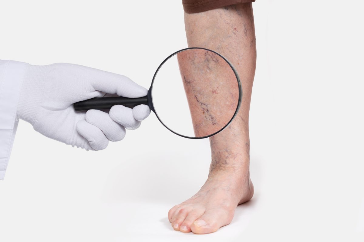 The concept of lasering spider veins is conceptualized by a doctor's hand holding a magnifying glass in front of a man's leg as he stands.