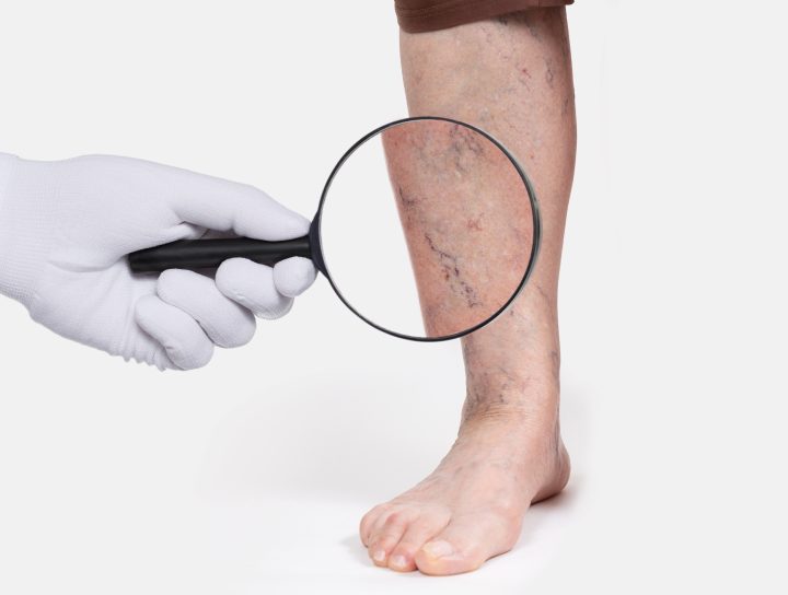 The concept of lasering spider veins is conceptualized by a doctor's hand holding a magnifying glass in front of a man's leg as he stands.